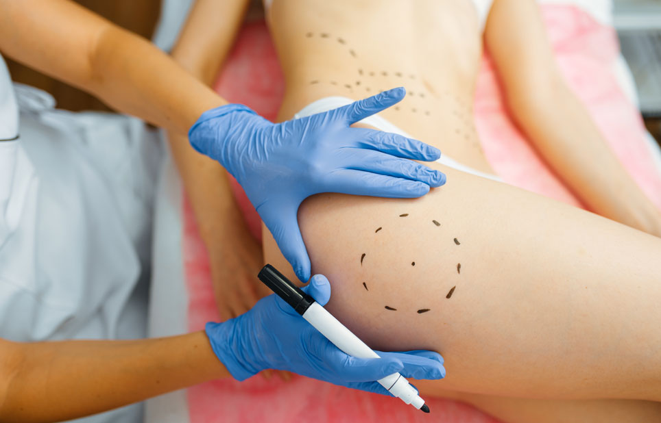 Fotografía mostrando marcas pre-operatorias para una cirugía estética, destacando el meticuloso enfoque de la Dra. Grecia, una cirujana plástica de renombre en Tijuana, Baja California