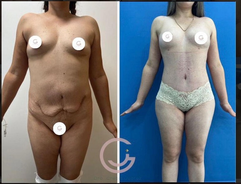 Fotografía de antes y después mostrando los impresionantes resultados de la cirugía estética realizada por la Dra. Grecia, una cirujana plástica de renombre en Tijuana, Baja California
