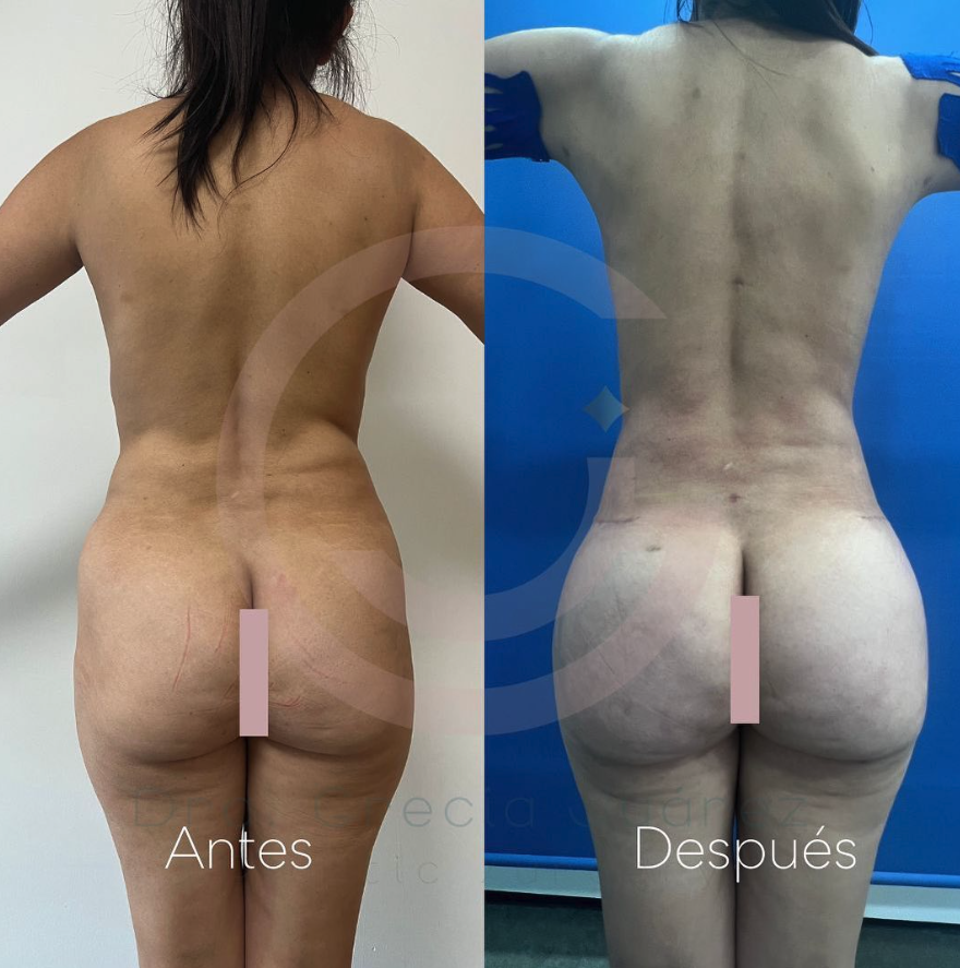 Fotografía de antes y después mostrando los impresionantes resultados de la cirugía estética realizada por la Dra. Grecia, una cirujana plástica de renombre en Tijuana, Baja California