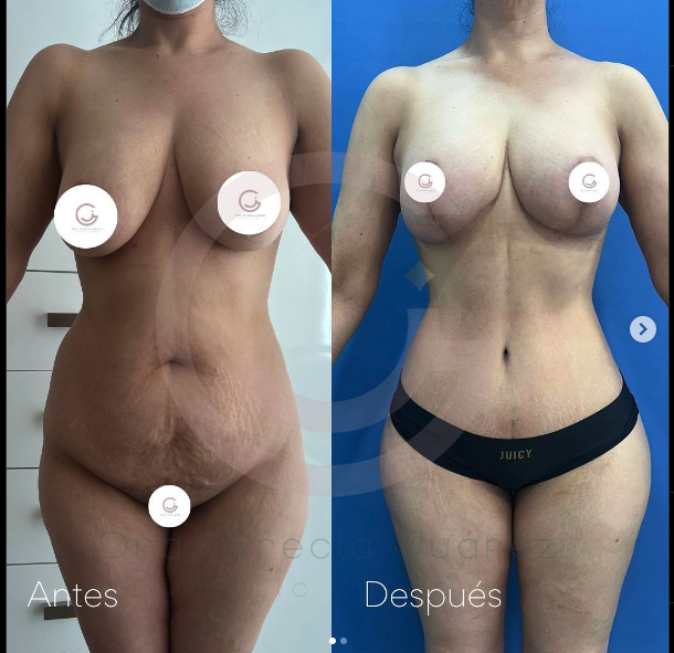 imagen de paciente antes y después de un tummy tuck realizado por la Dra. Grecia Juarez en Tijuana, mostrando una notable transformación hacia un abdomen más plano y estilizado.