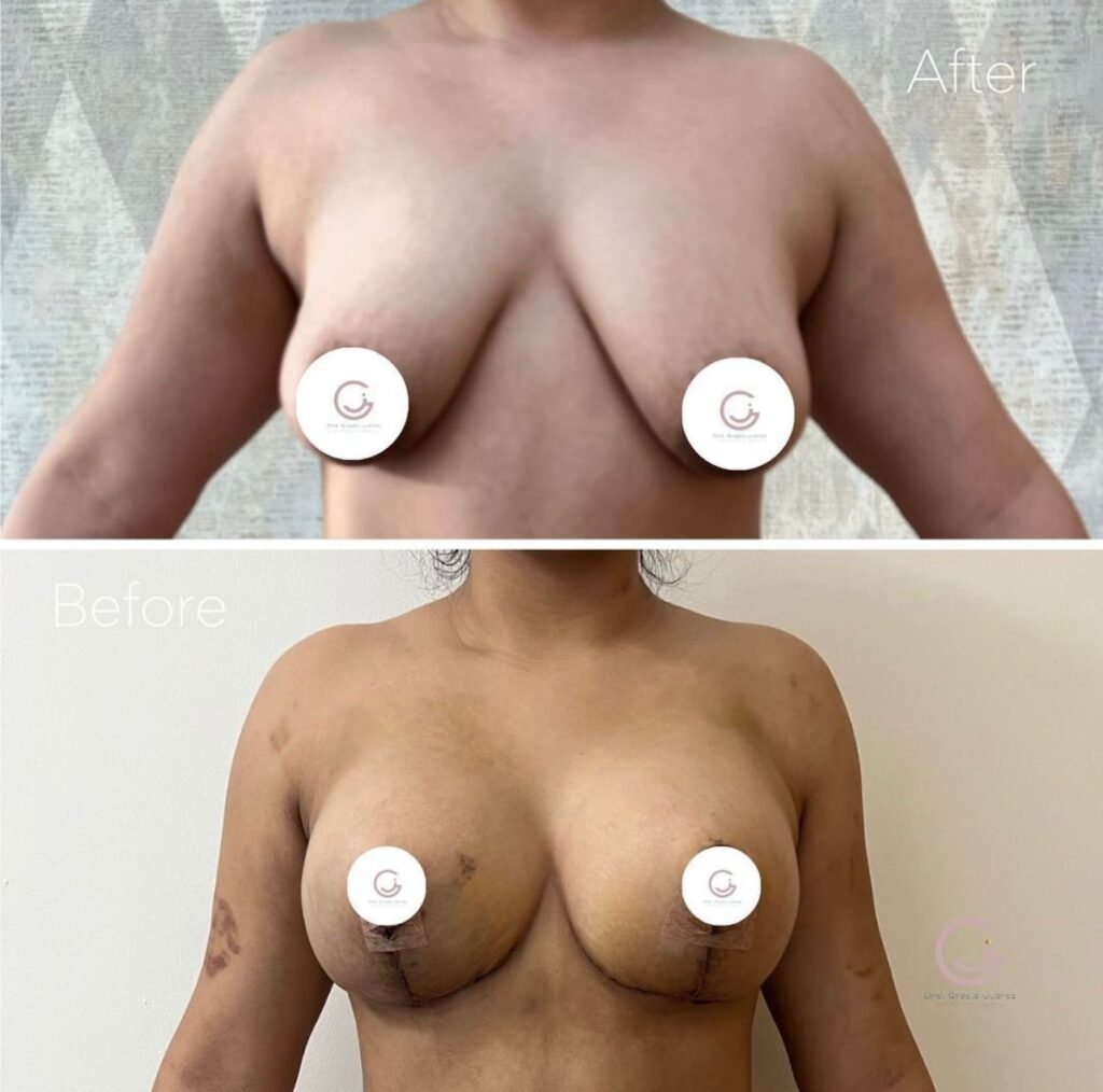 imagen de paciente antes y después Breast sugery realizado por la Dra. Grecia Juarez en Tijuana, mostrando una notable transformación más estilizado.