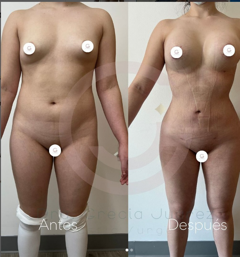 Before and after photo of a patient who underwent Body Lift surgery, showcasing a significantly tighter and more contoured body silhouette after the procedure