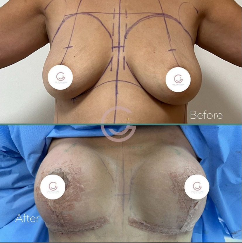 imagen de paciente antes y después Breast sugery realizado por la Dra. Grecia Juarez en Tijuana, mostrando una notable transformación más estilizado.