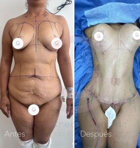 Before and after photo of a patient Tummy Tuck