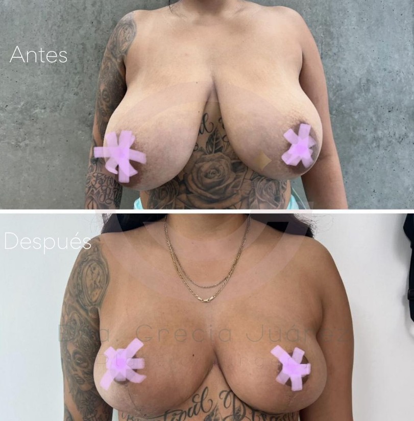 photo before and after breast reduction surgery