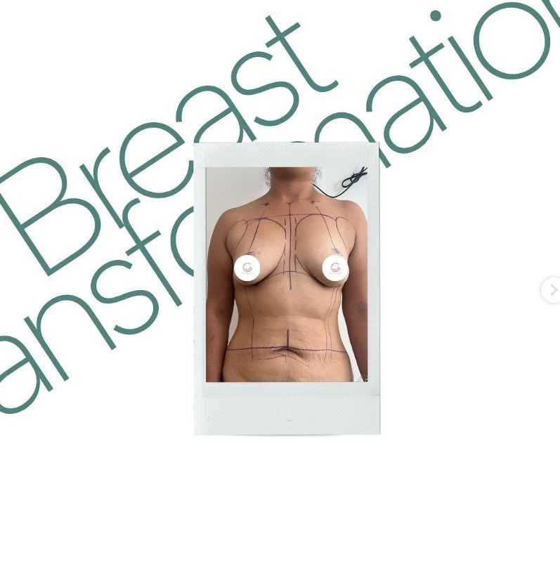 photo of a surgery breast Reconstruction in tijuana