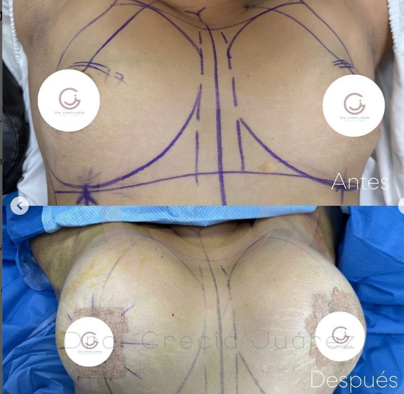 before and after patient surgery breast lift in tijuana