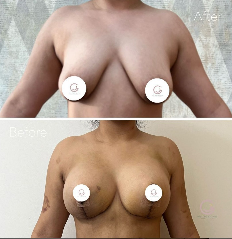 before and after patient surgery breast lift in tijuana