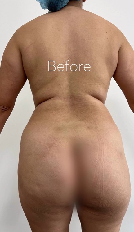 photo before liposuction surgery