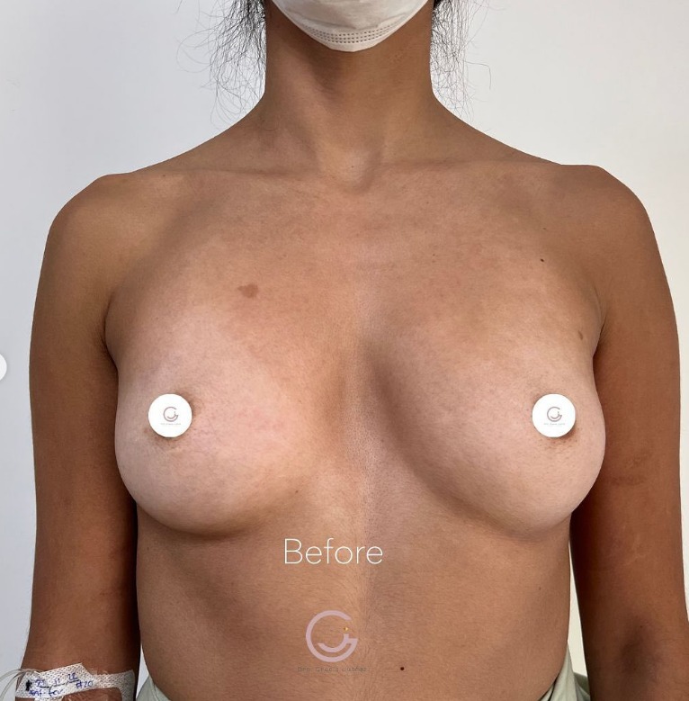 photo before Augmentation Surgery