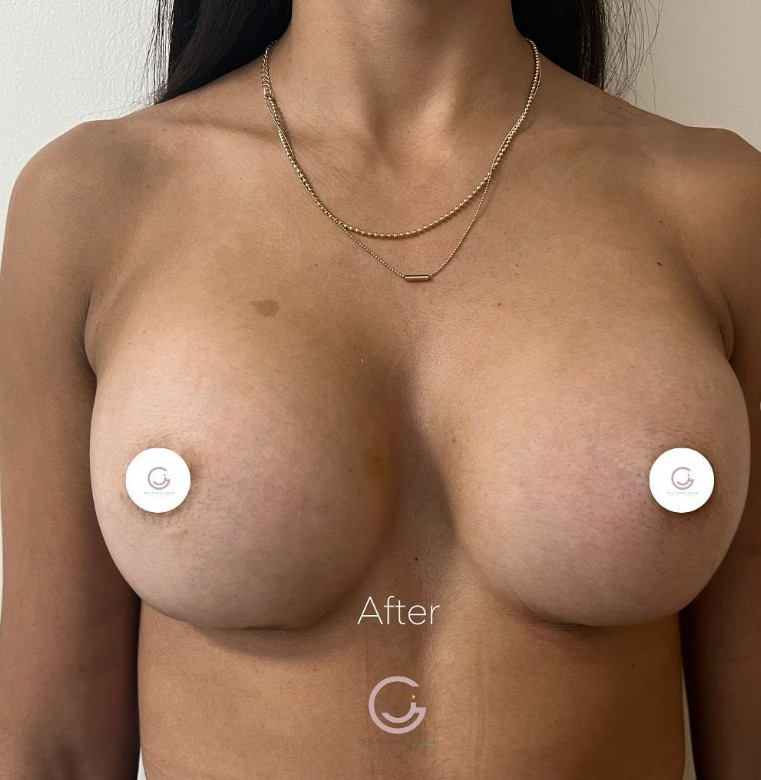 photo after Augmentation Surgery