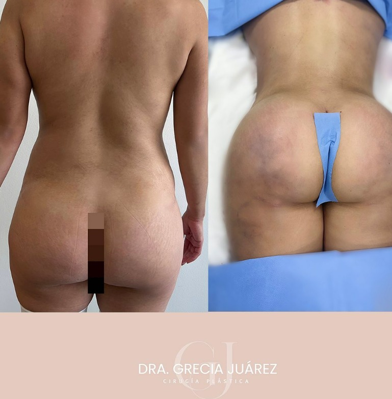 photo before and after liposuction sugery in tijuana