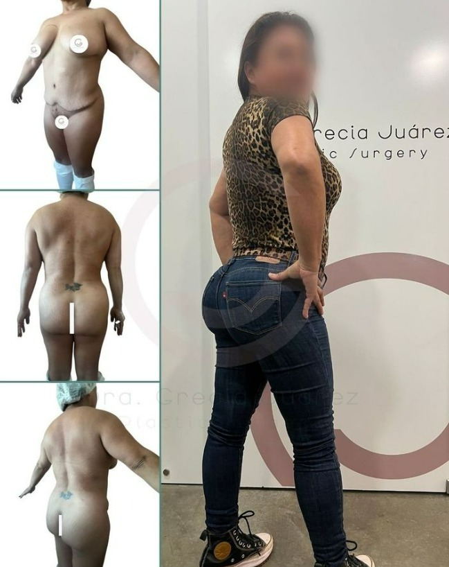 photo of before and after mommy make over in tijuana