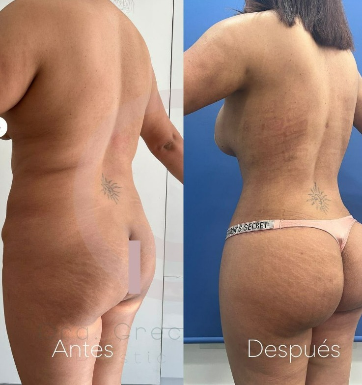 photo of before and after mommy make over in tijuana