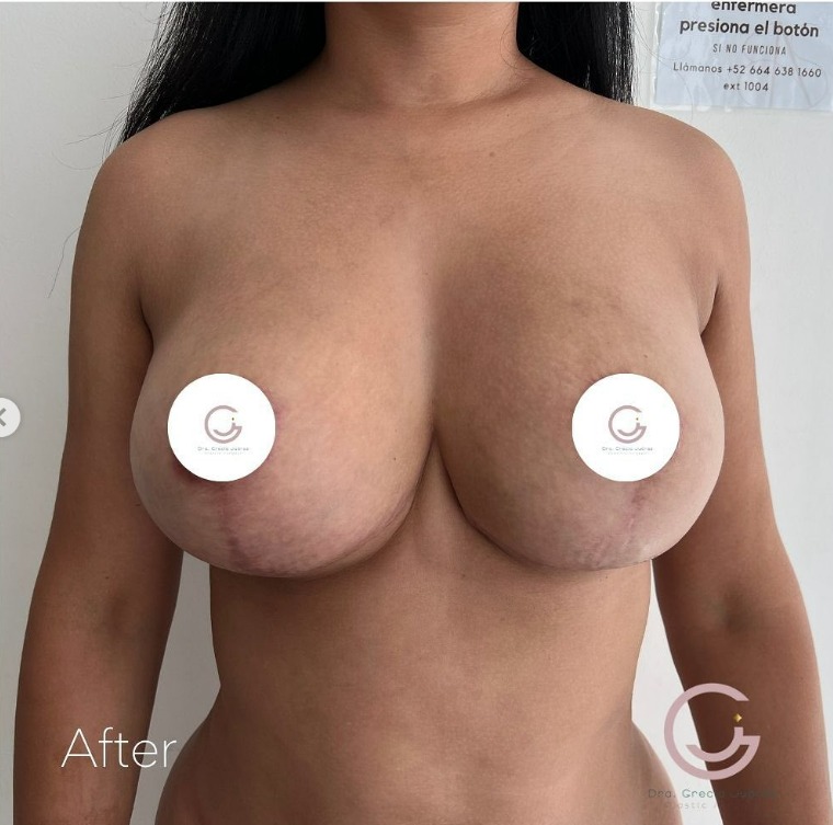 photo after Augmentation Surgery