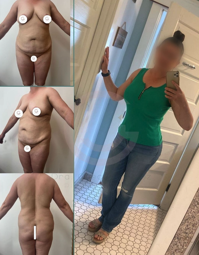 liga de lipotransferencia