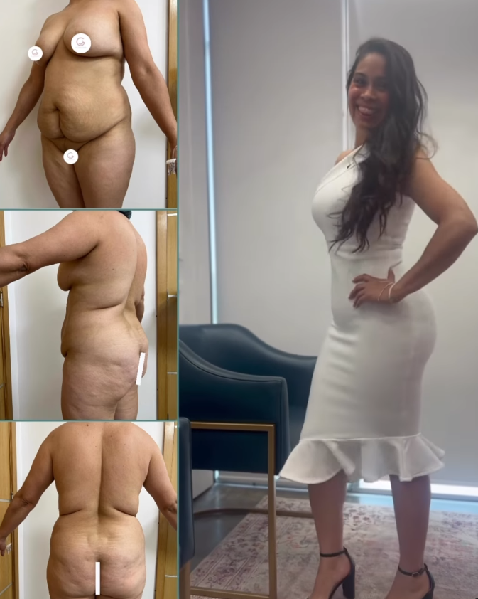 circular tummy tuck for a beautiful woman