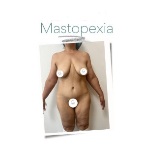 mastopexia imagen de una persona con el procedimiento