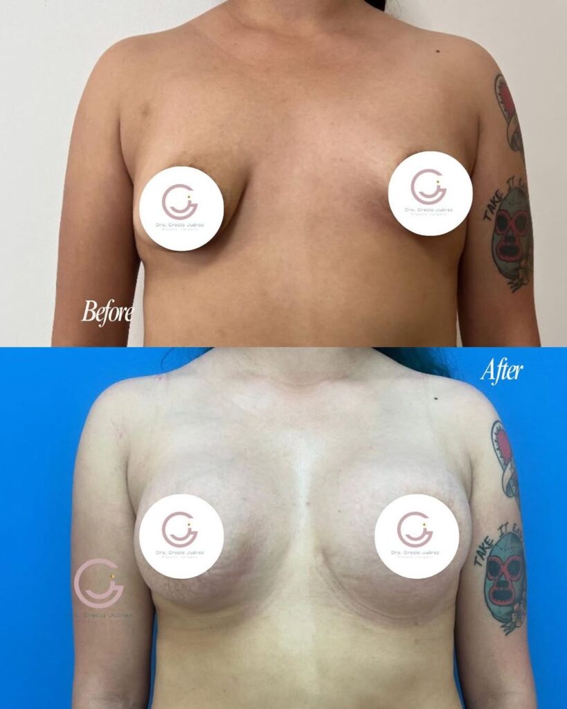 Photos Before and after Fat Transfer Breast Augmentation by Dra. Grecia Juarez