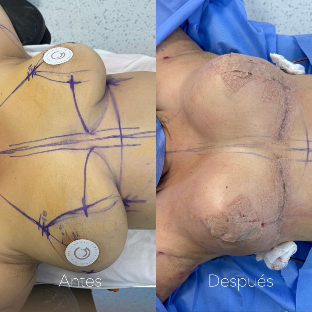 Before and after Fat Transfer Breast Augmentation by Dra. Grecia Juarez